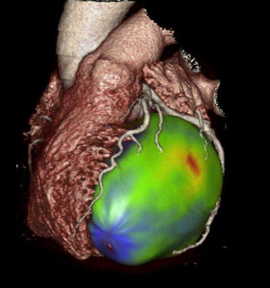 Nieuwe techniek voor meting van doorbloeding van de hartspier